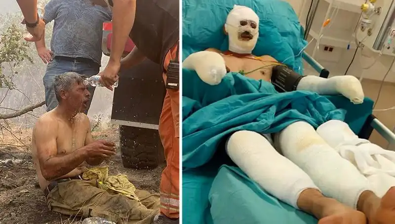 Yanıyorum Diyerek Feryat Eden Orman İşçisinin Hayat Mücadelesi Sürüyor